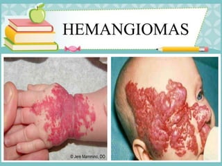 HEMANGIOMAS
 