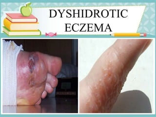 DYSHIDROTIC
ECZEMA
 