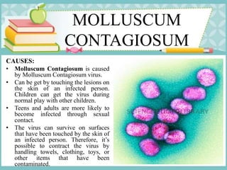 MOLLUSCUM
CONTAGIOSUM
CAUSES:
• Molluscum Contagiosum is caused
by Molluscum Contagiosum virus.
• Can be get by touching the lesions on
the skin of an infected person.
Children can get the virus during
normal play with other children.
• Teens and adults are more likely to
become infected through sexual
contact.
• The virus can survive on surfaces
that have been touched by the skin of
an infected person. Therefore, it’s
possible to contract the virus by
handling towels, clothing, toys, or
other items that have been
contaminated.
 