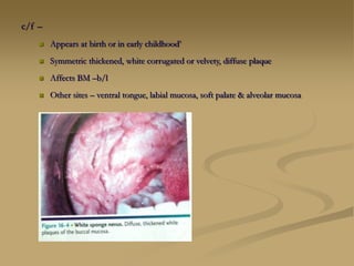 c/f –
 Appears at birth or in early childhood’
 Symmetric thickened, white corrugated or velvety, diffuse plaque
 Affects BM –b/l
 Other sites – ventral tongue, labial mucosa, soft palate & alveolar mucosa
 