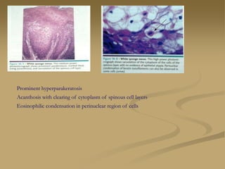 Prominent hyperparakeratosis
Acanthosis with clearing of cytoplasm of spinous cell layers
Eosinophilic condensation in perinuclear region of cells
 