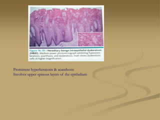 Prominent hyperkeratosis & acanthosis
Involves upper spinous layers of the epithelium
 