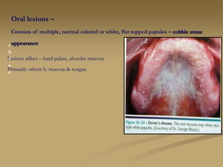 Oral lesions –
Consists of multiple, normal colored or white, flat topped papules – cobble stone
appearance
t
h
e
s
e
Lesions affect – hard palate, alveolar mucosa
Primarily others b. mucosa & tongue
 