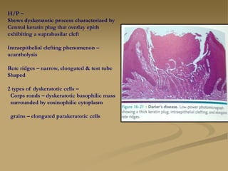 H/P –
Shows dyskeratotic process characterized by
Central keratin plug that overlay epith
exhibiting a suprabasilar cleft
Intraepithelial clefting phenomenon –
acantholysis
Rete ridges – narrow, elongated & test tube
Shaped
2 types of dyskeratotic cells –
Corps ronds – dyskeratotic basophilic mass
surrounded by eosinophilic cytoplasm
grains – elongated parakeratotic cells
 
