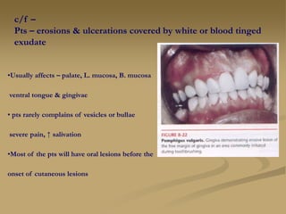 c/f –
Pts – erosions & ulcerations covered by white or blood tinged
exudate
•Usually affects – palate, L. mucosa, B. mucosa
ventral tongue & gingivae
• pts rarely complains of vesicles or bullae
severe pain, ↑ salivation
•Most of the pts will have oral lesions before the
onset of cutaneous lesions
 