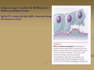 Antigenic targets – laminin 5 & 180 KD protein –
Bullous pemphigoid antigen
IgG & C3 – along with IgA, IgM – deposited along
the basement memb
 