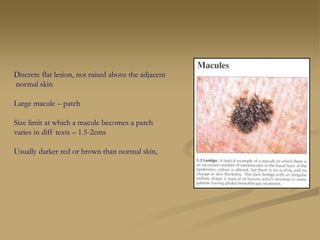 Discrete flat lesion, not raised above the adjacent
normal skin
Large macule – patch
Size limit at which a macule becomes a patch
varies in diff texts – 1.5-2cms
Usually darker red or brown than normal skin,
 