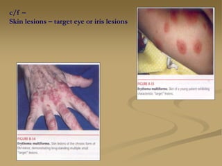 c/f –
Skin lesions – target eye or iris lesions
 