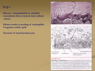h/p –
Mucosa – intraepithelial or subepith
vesiculation Due to intra & inter cellular
edema
Edema results in pooling of eosinophilic
Coagulum within epith
Necrosis of basal keratinocytes
 
