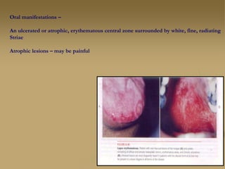 Oral manifestations –
An ulcerated or atrophic, erythematous central zone surrounded by white, fine, radiating
Striae
Atrophic lesions – may be painful
 