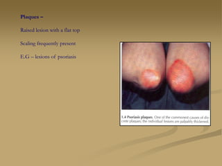 Plaques –
Raised lesion with a flat top
Scaling frequently present
E.G – lesions of psoriasis
 