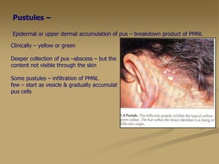 Pustules –
Epidermal or upper dermal accumulation of pus – breakdown product of PMNL
Clinically – yellow or green
Deeper collection of pus –abscess – but the
content not visible through the skin
Some pustules – infiltration of PMNL
few – start as vesicle & gradually accumulat
pus cells
 