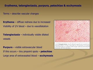 Erythema, telangiectasia, purpura, petechiae & ecchymosis
Terms – describe vascular changes
Erythema – diffuse redness due to increased
Visibility of I/V blood – due to vasodilatation
Telangiectasia – individually visible dilated
vessels
Purpura – visible extravascular blood
If this occurs – tiny pinpoint spots – petechiae
Large area of extravasated blood – ecchymosis
 