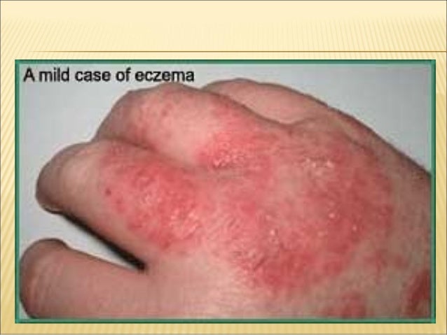 codeine skin disorder codeine skin disorder