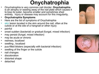 Onychatrophia Onychatrophia is very common nail diorder.  Onychatrophia  is an atrophy or wasting away of the nail plate which causes it to lose its luster, become smaller and sometimes shed entirely.  Injury or disease may account for this irregularity.  Onychatrophia Symptoms Here are the list of symptoms of Onychatrophia skin  lesion located in the skin around the nail, often at the cuticle or at the site of a hangnail or other injury  painful  onset sudden (bacterial) or gradual (fungal, mixed infection)  may persist (fungal, mixed infection)  may be acute or chronic  redness, localized  swelling , localized  pus-filled blisters (especially with bacterial infection)  swelling of the finger or the cuticle  nail changes  discoloration  distorted shape  detached  
