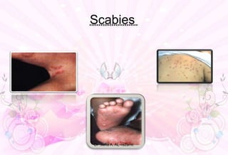 Scabies
Dr .safia A. AL-rezami.
 