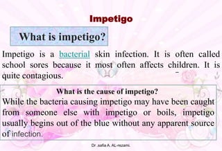 –
Impetigo
What is impetigo?
Impetigo is a bacterial skin infection. It is often called
school sores because it most often affects children. It is
quite contagious.
What is the cause of impetigo?
While the bacteria causing impetigo may have been caught
from someone else with impetigo or boils, impetigo
usually begins out of the blue without any apparent source
of infection.
Dr .safia A. AL-rezami.
 