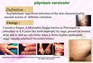 Asymptomatic superficial infwction of the skin characterized by
macular lesions of different coloration .
pityriasis versicolor
Definition :
Causative fungus. A Dimorphic fungus known as Pityrospon.m
orbicular» in iLS yeast-like form (saproph}'tic stage, present on normal
skin) and as Mal ass erla furfur when it forms hyphae (pathogenic
stage. causing pityriasis versicolor lesions
Etiology :
Superficial candidiasis infections are limited to the skin and mucous membranes
Dr .safia A. AL-rezami.
 