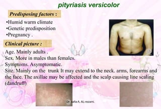 •Humid warm climate
•Genetic predisposition
•Pregnancy .
pityriasis versicolor
Predisposing factors :
Age. Mainly adults .
Sex. More in males than females.
Symptoms. Asymptomatic.
Site. Mainly on the trunk It may extend to the neck. arms, forearms and
the face. The axillae may be affected and the scalp causing line scaling
(dandruff(
Clinical picture :
Dr .safia A. AL-rezami.
 
