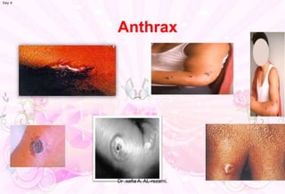 Anthrax
Day 4
Dr .safia A. AL-rezami.
 