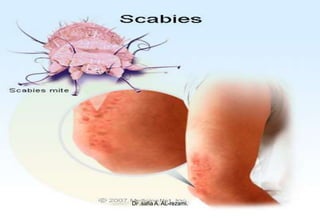 Scabies
Scabies
Dr .safia A. AL-rezami.
 