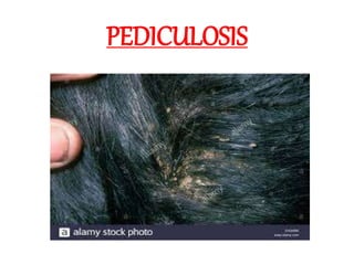 PEDICULOSIS
 