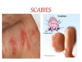SCABIES
 