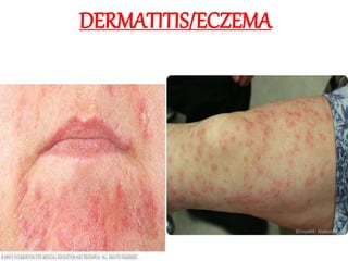 DERMATITIS/ECZEMA
 