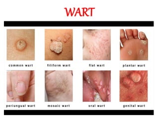 WART
 
