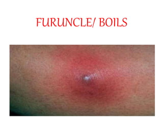 FURUNCLE/ BOILS
 