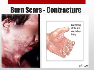 Scar Contraction Skin disorders-wound healing | PPTX