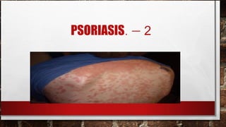 PSORIASIS. – 2
 
