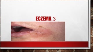 ECZEMA.3
 