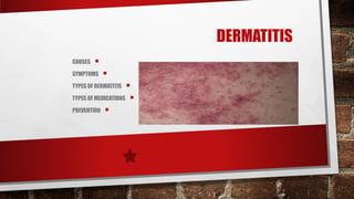 DERMATITIS
CAUSES   
SYMPTOMS     
TYPES OF DERMATITIS 
TYPES OF MEDICATIONS 

PREVENTION 
 
