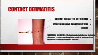 CONTACT DERMATITIS
                       .CONTACT DERMATITIS WITH NICKEL               •
                     REDDISH MARKING AND ITCHING WILL                •
                                                         .OCCUR

               SEBORRHEIC DERMATITIS: Medications include but not limited to
               shampoos, creams containing ketocanzole or hydrocortisone.
               For severe cases use ultraviolet radiation.
 