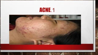 ACNE.1
 