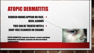 ATOPIC DERMATITIS
REDDISH MARKS APPEAR ON FACE,                     •
               .NECK ,ELBOWS
    THIS CAN BE TREATED WITH A                    •
.SOAP-FREE CLEANSER OR CREAMS

ATOPIC DERMATITIS: soap-free cleanser, creams containing
alphahydrox acid lotions. A person can also use topical
antihistamines
 