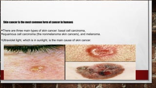 Skin cancer is the most common form of cancer in humans

•There are three main types of skin cancer: basal cell carcinoma,
•squamous cell carcinoma (the nonmelanoma skin cancers), and melanoma.
•Ultraviolet light, which is in sunlight, is the main cause of skin cancer.
 