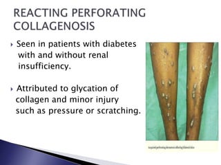 Endocrine Rashes Skin or Dermatological Manifestations of Endocrine Diseases | PPTX