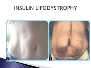 Endocrine Rashes Skin or Dermatological Manifestations of Endocrine Diseases | PPTX