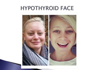 Endocrine Rashes Skin or Dermatological Manifestations of Endocrine Diseases | PPTX