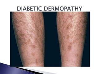 Endocrine Rashes Skin or Dermatological Manifestations of Endocrine Diseases | PPTX
