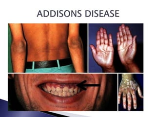 Endocrine Rashes Skin or Dermatological Manifestations of Endocrine Diseases | PPTX