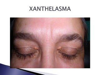 Endocrine Rashes Skin or Dermatological Manifestations of Endocrine Diseases | PPTX