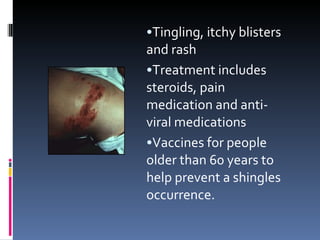 Tingling, itchy blisters and rash Treatment includes steroids, pain medication and anti-viral medications Vaccines for people older than 60 years to help prevent a shingles occurrence. 