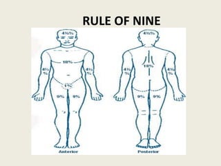 RULE OF NINE
 