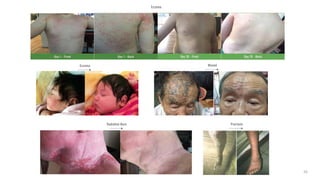 Eczema Wound
Radiation Burn Psoriasis
Eczema
!"#$%&'"()*+,-"').-)-
!"#$%"&'()*+&,-.%/0'%&1($%)2()(&3%"24 .#/"%&'()*+&,-.%/0'%&1($%)2()(&3%"24&56&7""8(&92/"%:
!*
 