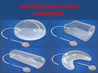 Tissue Expansion For Rfff Skin Expansion | PPTX