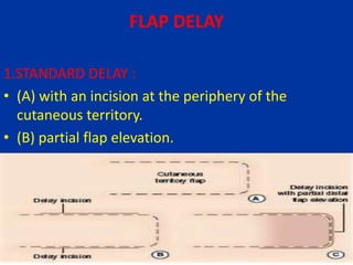 FLAP DELAY
1.STANDARD DELAY :
• (A) with an incision at the periphery of the
cutaneous territory.
• (B) partial flap elevation.
 