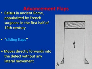 Advancement Flaps
• Celsus in ancient Rome,
popularized by French
surgeons in the first half of
19th century
• “sliding flaps”
• Moves directly forwards into
the defect without any
lateral movement
 